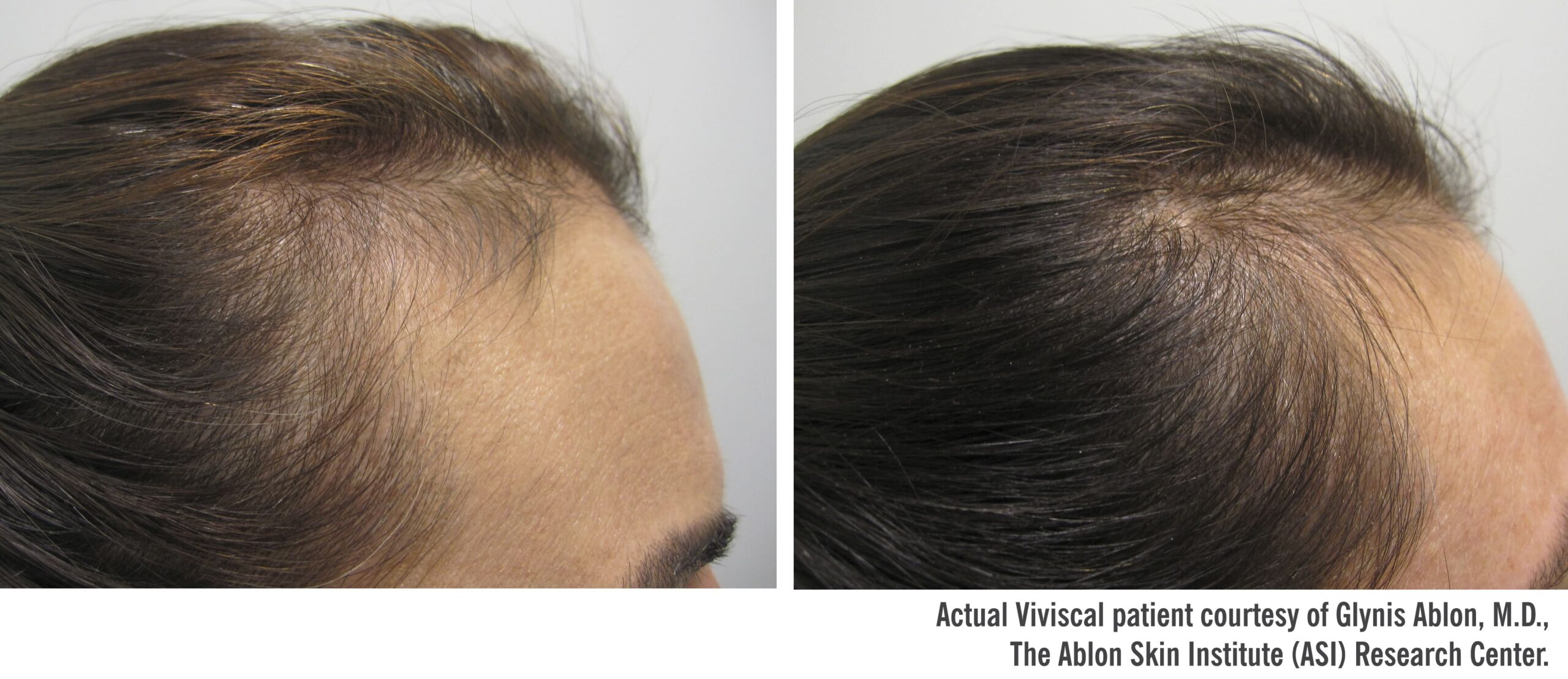 Viviscal - Before & After 90 Day - 6_71093206-4537-4c89-819e-0548632ce567